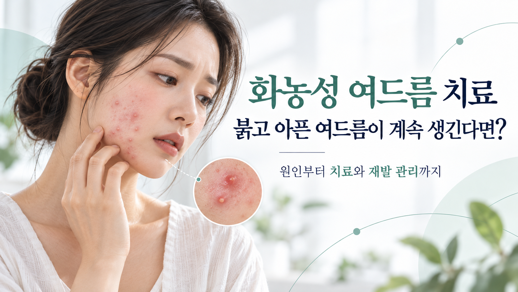 화농성 여드름 치료 붉고 아픈 여드름이 계속 생긴다면?