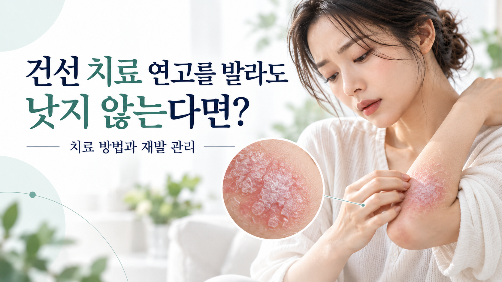 건선 치료 연고를 사용해도 팔꿈치에 각질과 붉은 병변이 반복되는 증상