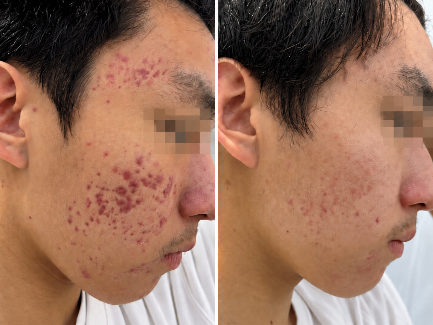여드름 OR 여드름흉터